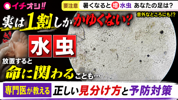 【かゆくない水虫が9割？】専門医に聞く、足以外にも広がる意外な症状と今日からできる予防法　サムネイル